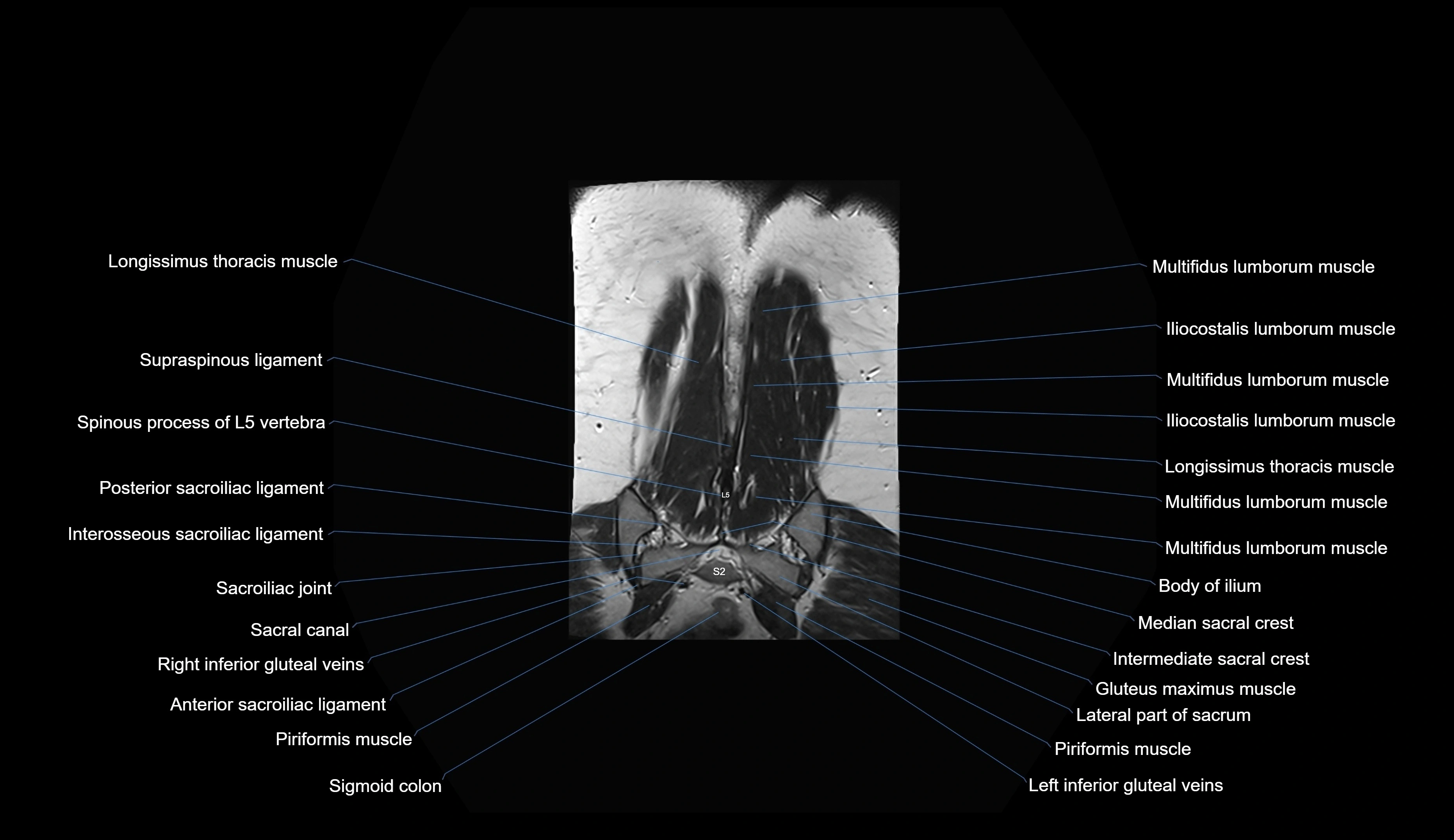 MRI lumbar spine coronal cross sectional anatomy 3T radiology  image-img-00001-00035.webp